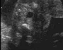 Sacrococcygeal teratoma, video clip image