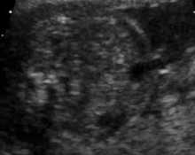 Umbilical vein varix, video-clip image