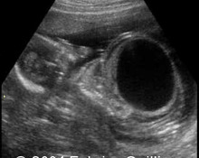 Posterior urethral valves, 15 weeks image