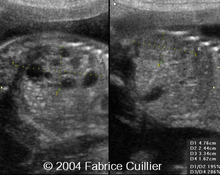 Multicystic kidney disease, unilateral, in a twin image