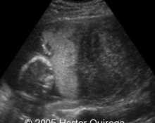 Uterine myoma and pregnancy image