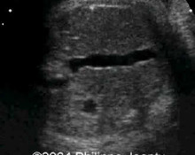 Trisomy 21, video clip image
