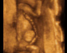 Gastroschisis, 3D representation at 16 weeks image
