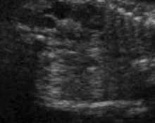 Multicystic dysplastic kidneys, video clip image