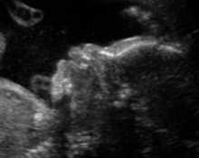 Cleft lip unilateral, 26 weeks image