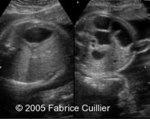 Jejunal atresia in a twin gestation image