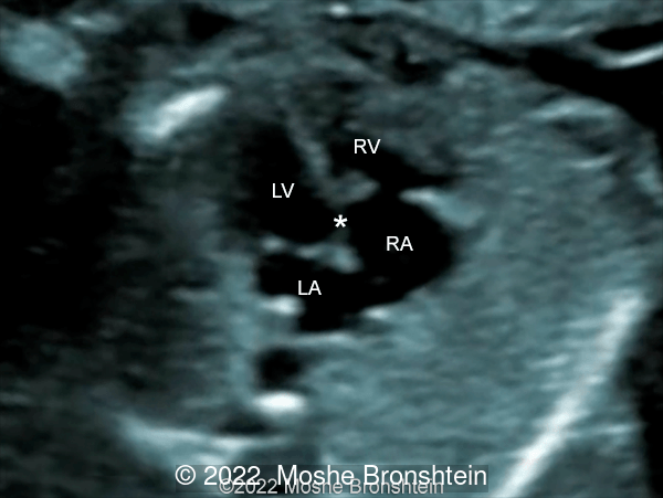 Gerbode defect (*) associated with Ebstein's anomaly at 16 weeks gestation.