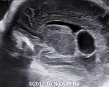 Ventricular cyst image