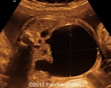 Ectopic kidney, uretero-pelvic junction obstruction image