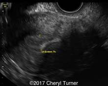 Ectopic pregnancy - Monochorionic monoamniotic image