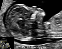 Spontaneus Endogenous Ovarian Hyperstimulation image