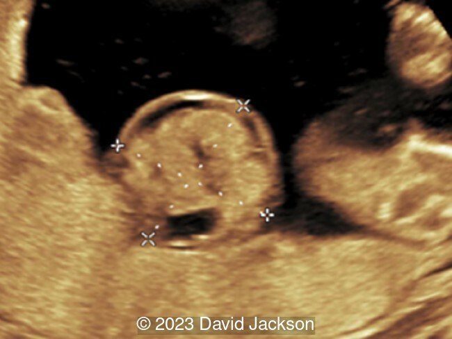 28 weeks gestation