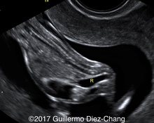 Imperforated anus - First Trimester image