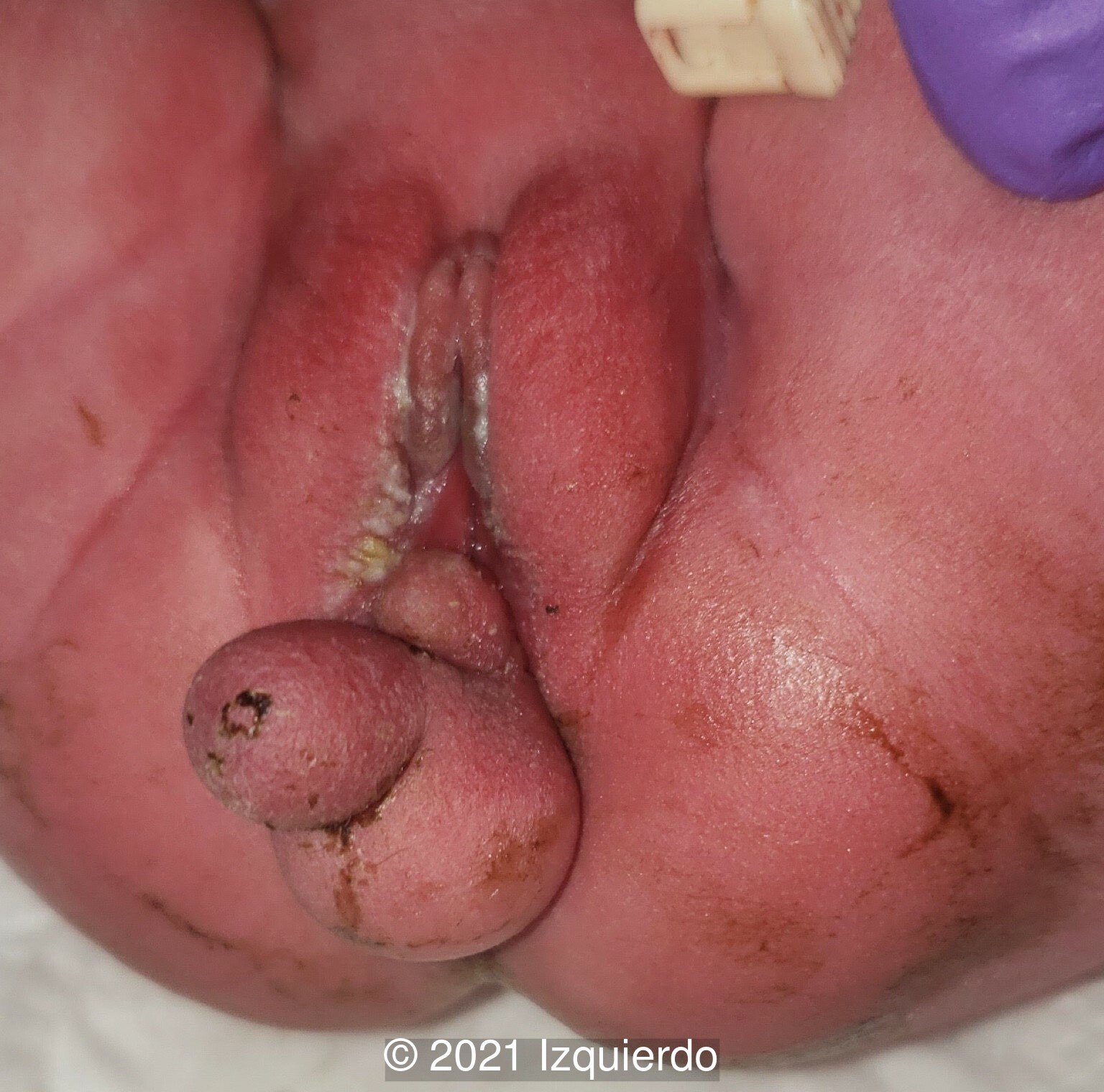Pre-operative image of the perineal mass.
