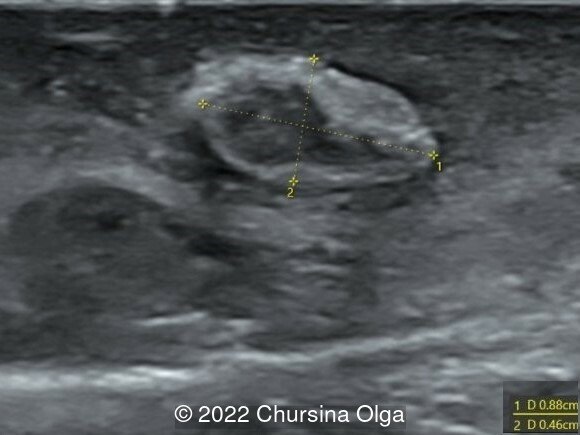 Normal structure of the contralateral right testicle of a newborn