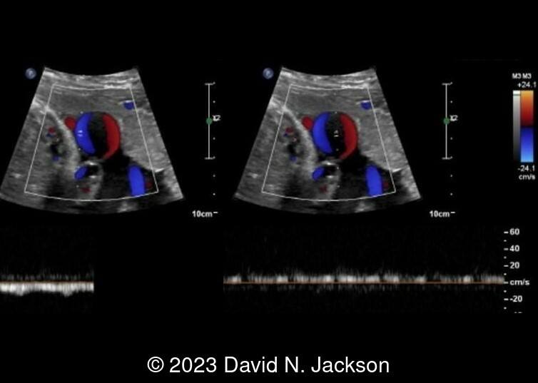 Doppler on left and mid section of cyst.