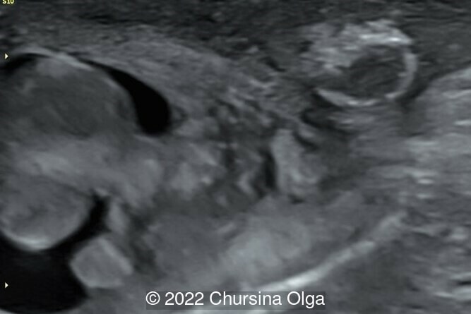 Postnatal structure of the left testicle of a 3-day-old newborn