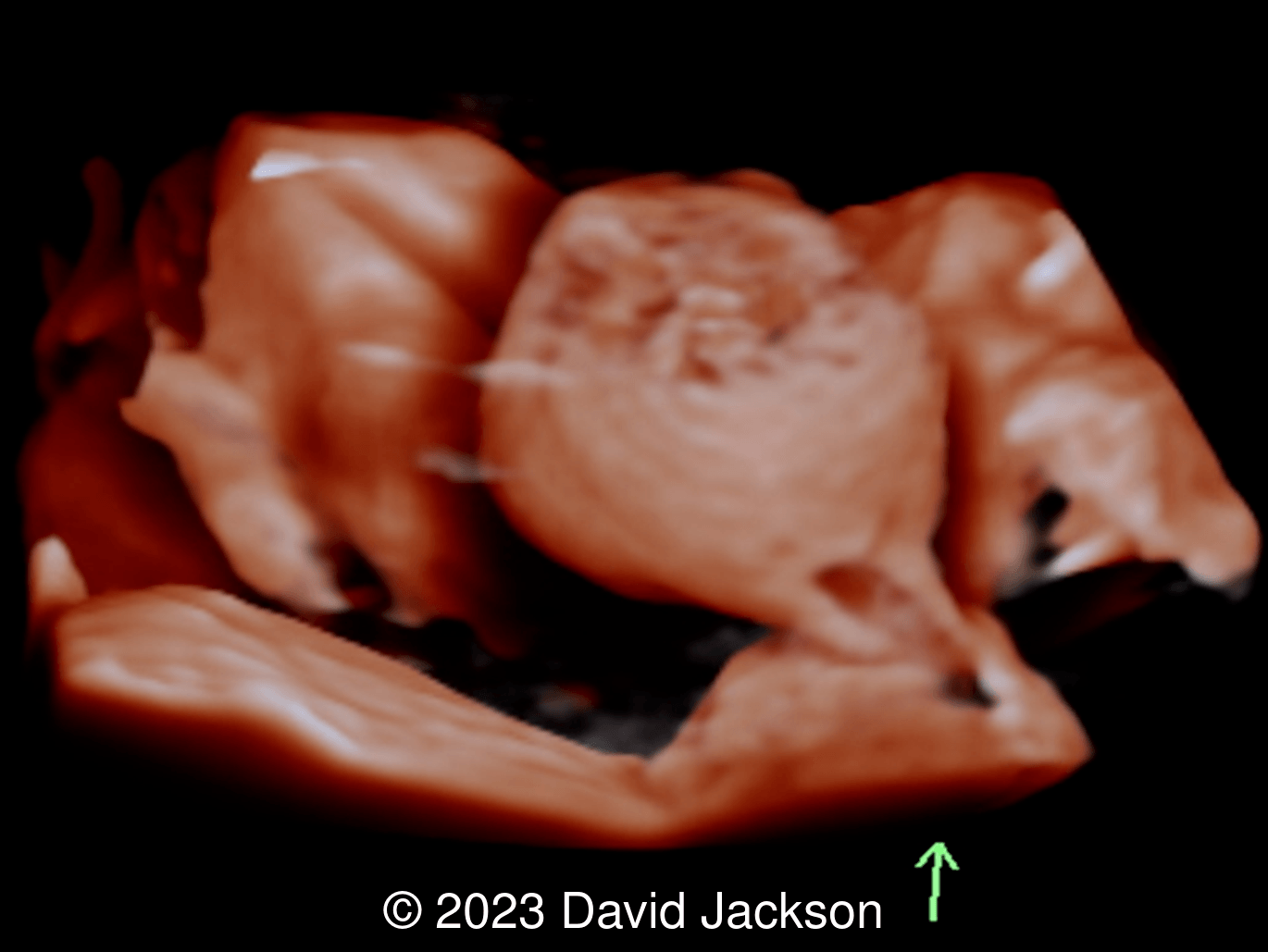 26 6/7 weeks gestation