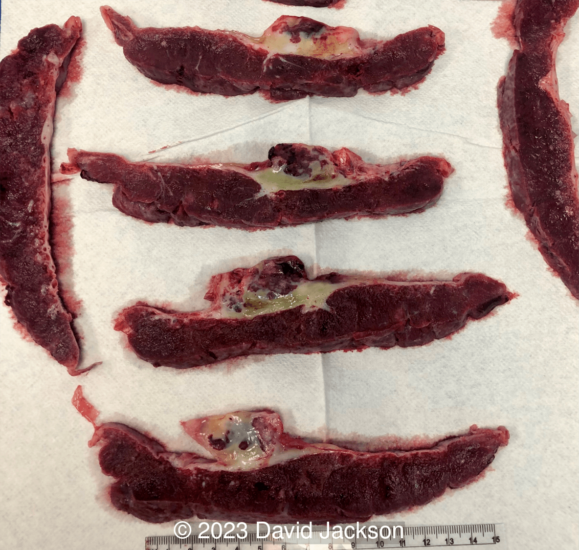 Central dense mass with thin-walled, dilated vascular channels distributed in a myxoid matrix on histology. 