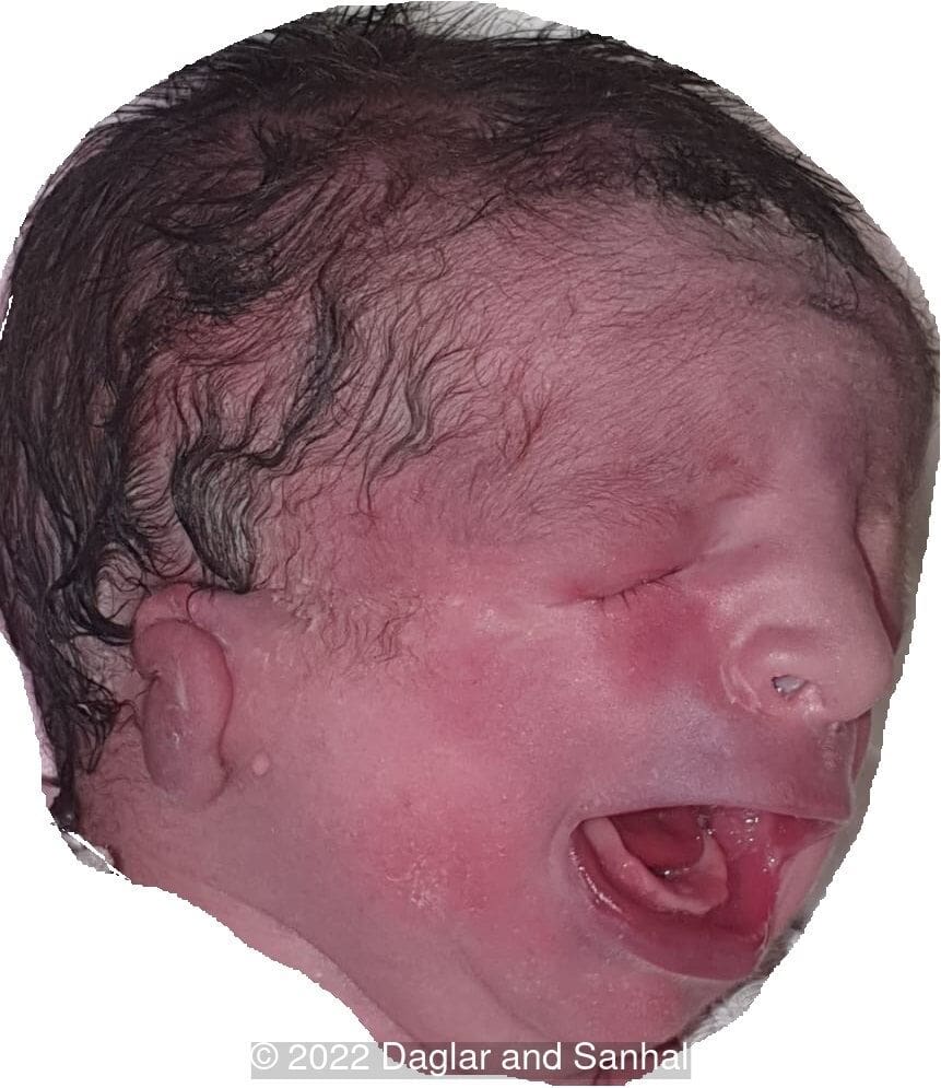 Typical features of Treacher Collins Syndrome including downslanting palpebral fissures, zygomatic arch and malar hypoplasia, malformed pinnas, small mandible and relative macrostomia.