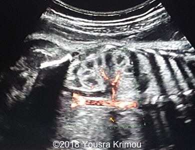 Image showing the absence of the left kidney1