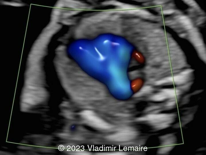 Azygos vein draining into the SVC, and ARSA coursing posterior to the trachea and esophagus and toward the right arm, in a fetus at 19 weeks of gestation.