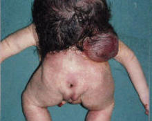 Iniencephaly image