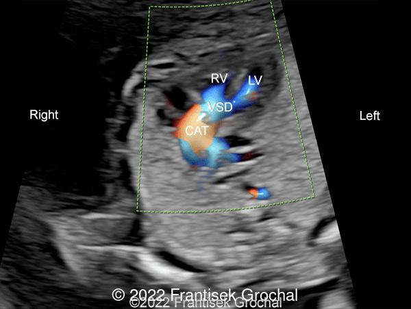 Color Doppler 4-chamber view of the heart showing Common Arterial Trunk (CAT) overriding ventricular septal defect (VSD). RV - right ventricle, LV - left ventricle.