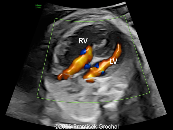 Color flow mapping demonstrating blood flow entering the ventricles in diastole (RV-right ventricle; LV-left ventricle)