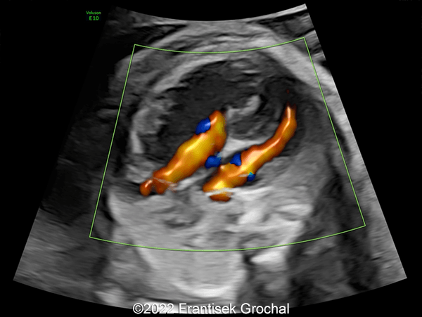 Color flow mapping demonstrating blood flow entering the ventricles in diastole
