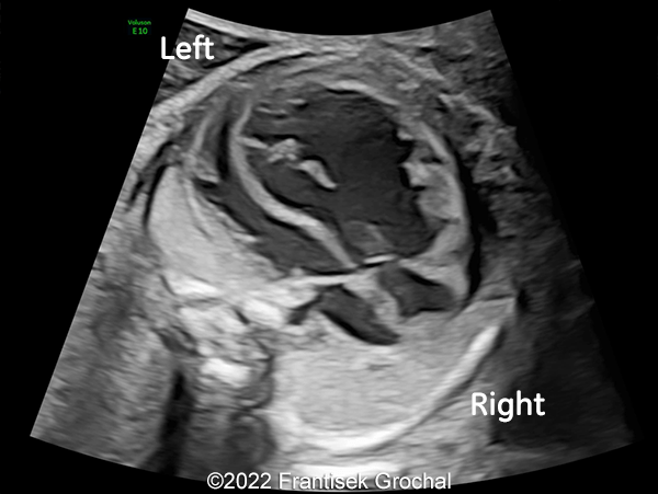 Four-chamber view of the heart