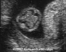 Ultrasound examination in the first trimester image