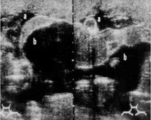 Placental abruption in a twin pregnancy image
