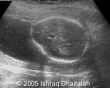 Recessive kidney disease in one of the twin gestation image