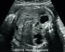 Posterior urethral valves image