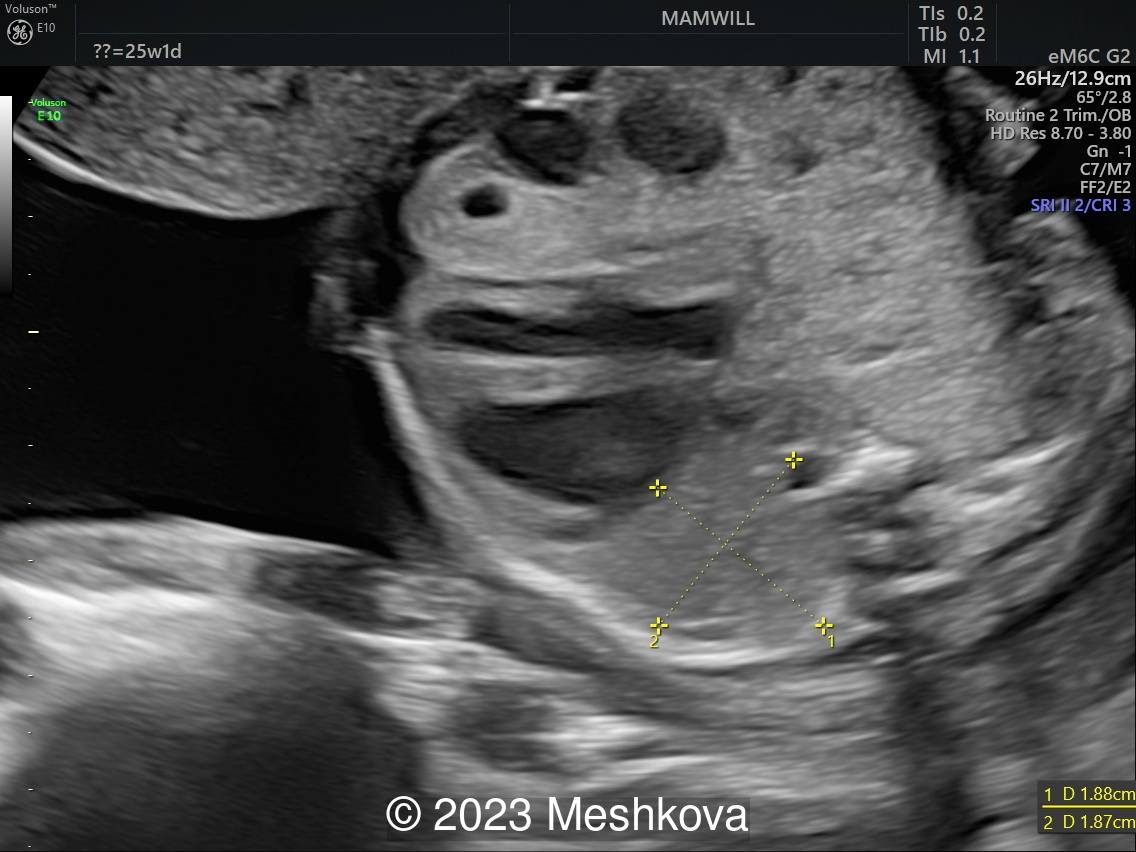 25-26 weeks transverse scan of the fetal thorax   with measurements  of  intact lung