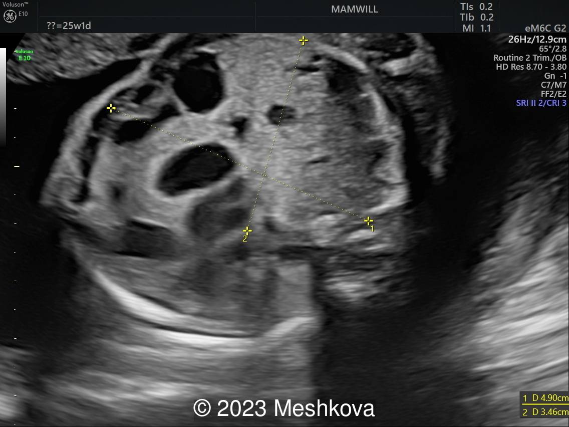 25-26 weeks transverse scan of the fetal thorax   with measurements  of affected lung