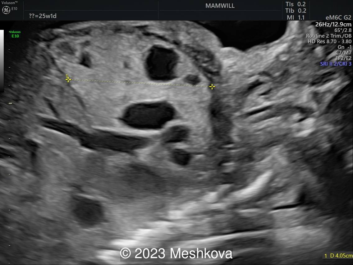 25-26 weeks parasagittal scan of the fetal thorax  with measurements of affected lung