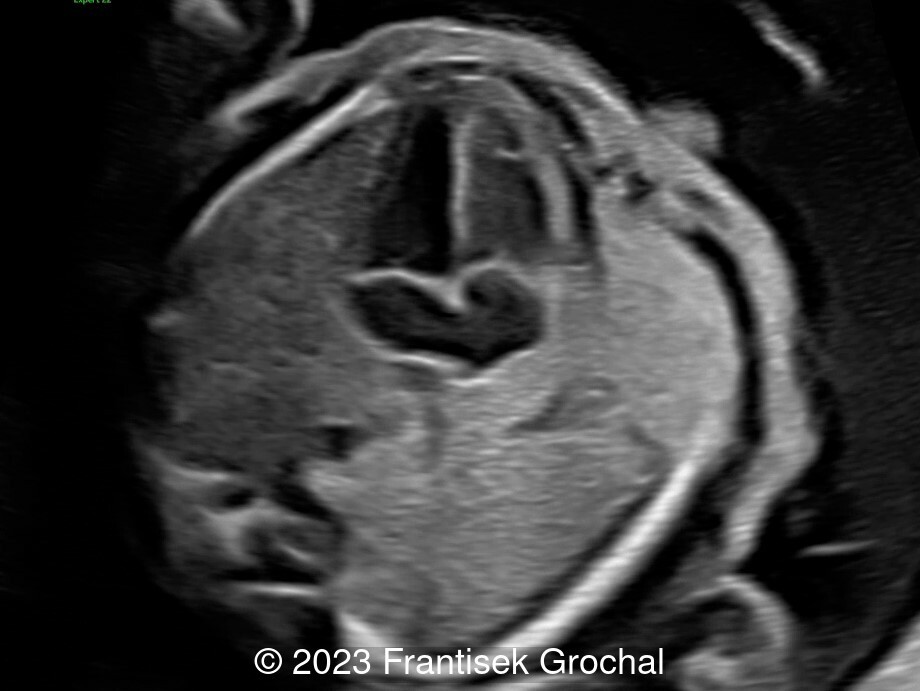 4-chamber view of the heart showing enlarged posterior left atrial space.