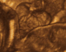 Gastroschisis, 3D representation at 20 weeks image