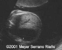 Liver cyst, spontaneous resolution image
