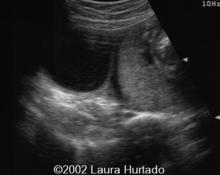Pregnancy in a bicornuate uterus image
