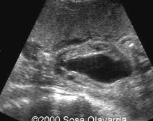 Cloacal dysgenesis with imperforate anus image
