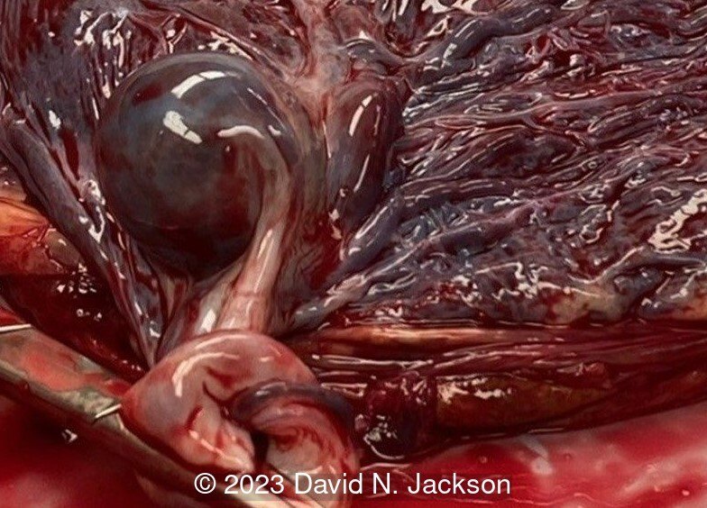 Pathology specimen demonstrating the umbilical artery aneurysm. 