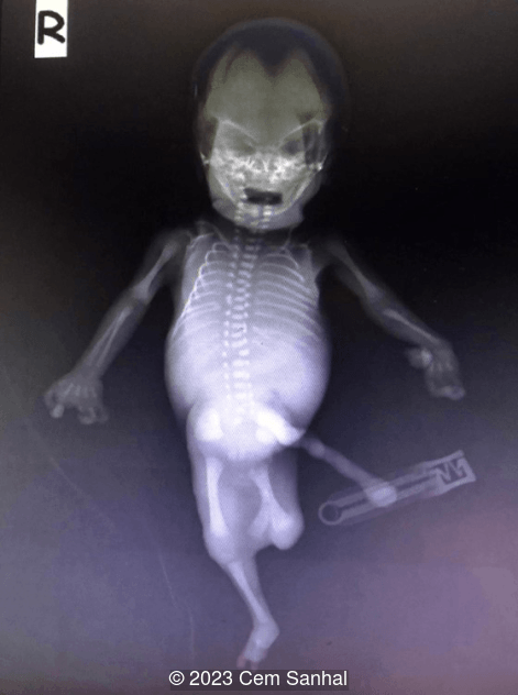Postabortal x-ray demonstrating duplication of left femur with absence of distal parts, hemivertebra, ectrodactyly of extremities, and absence of left radius.