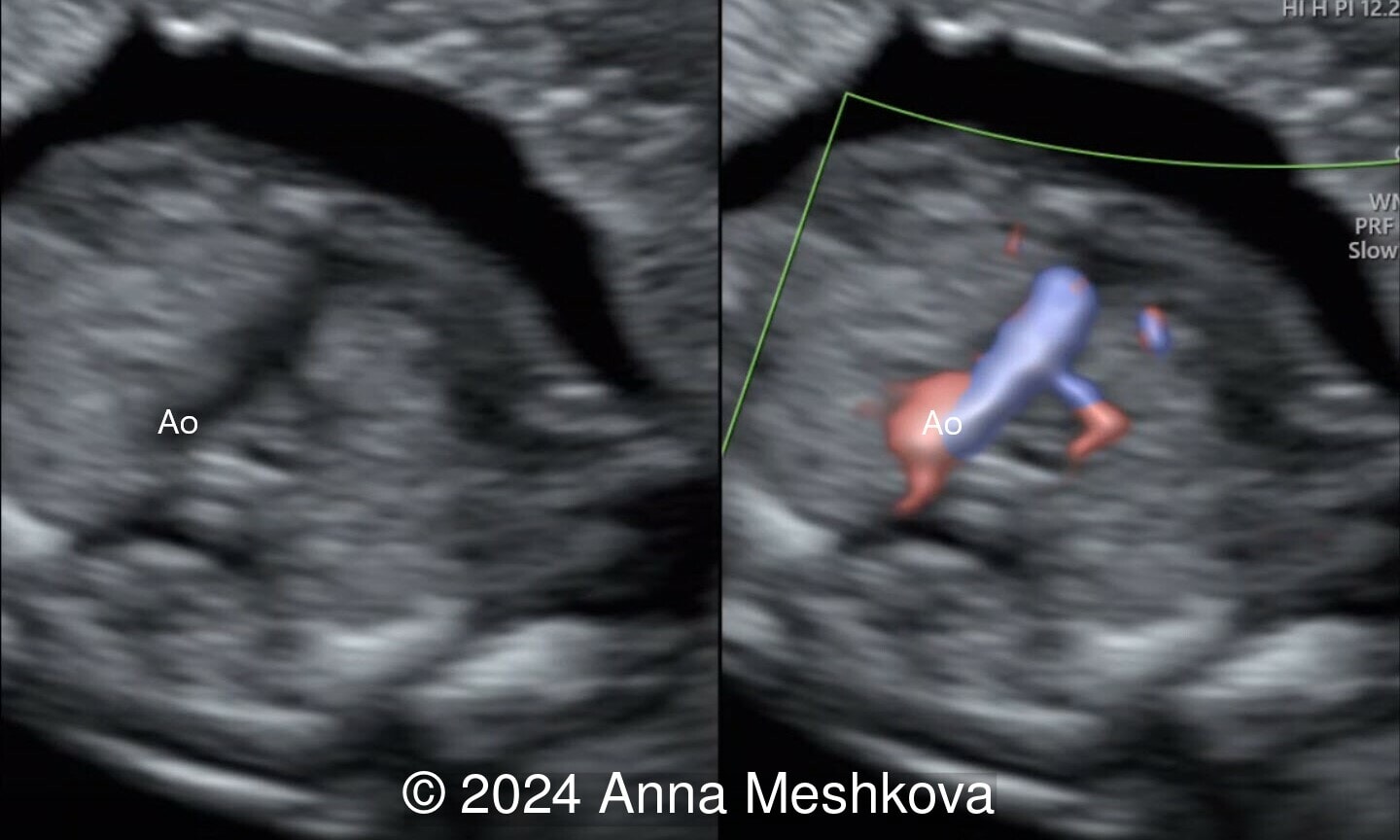 Ao: Aorta