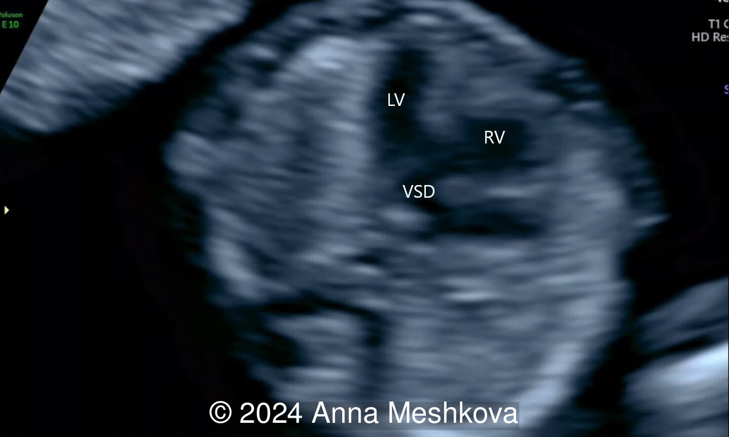 LV: left ventricle; RV: right ventricle; VSD: ventricular septal defect