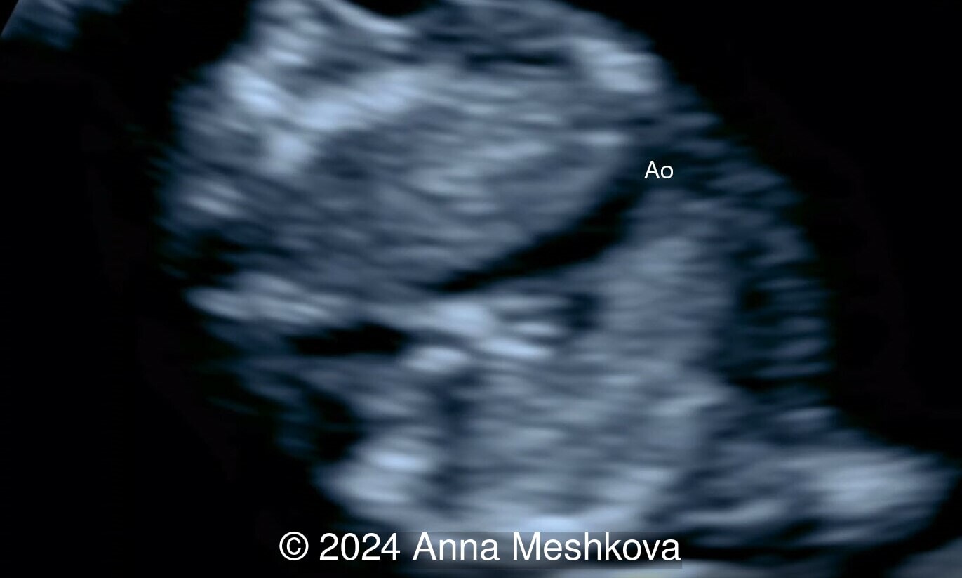 Ao: Aorta
