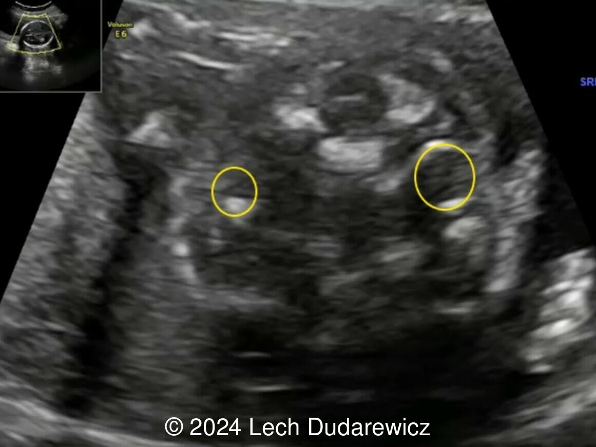 The outline of the tympanic ring is marked by the yellow circles. Note the hypoplasia of the tympanic ring on the right side.