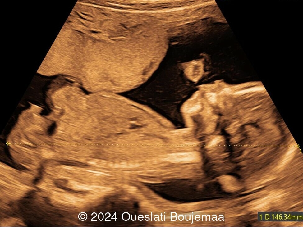 18 weeks gestation